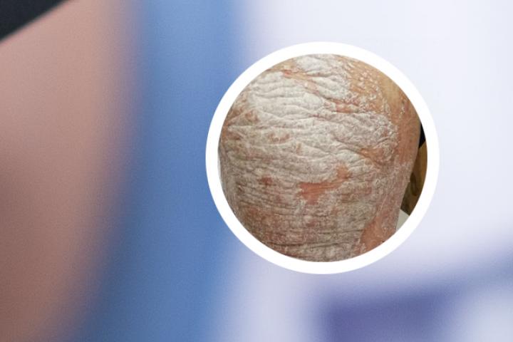 原浆去屑银屑病能用吗