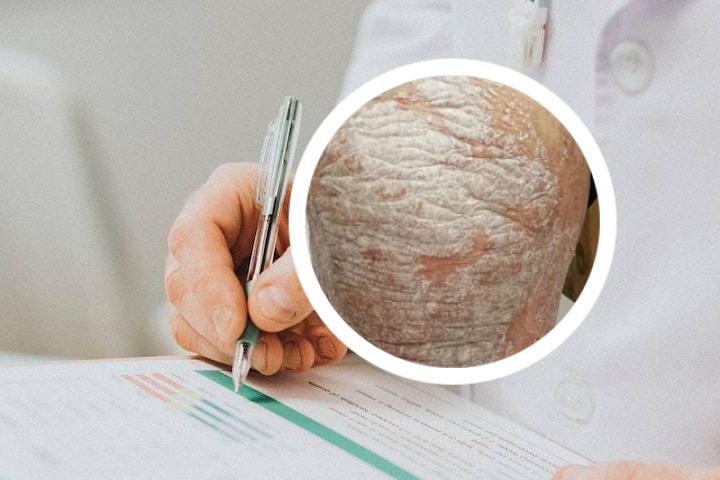 牛皮癣可以吃河豚么
