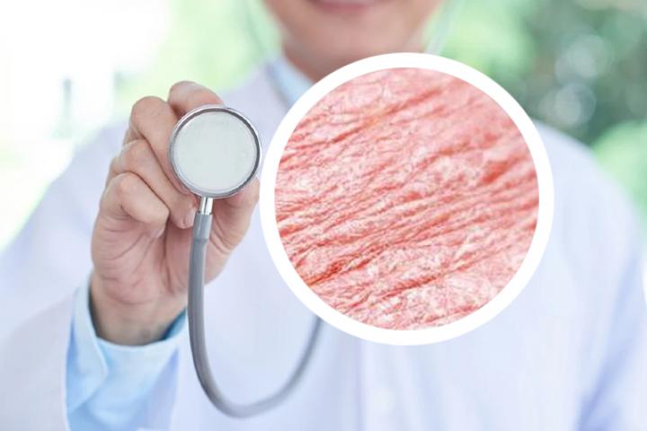 注射干细胞能治疗银屑病吗
