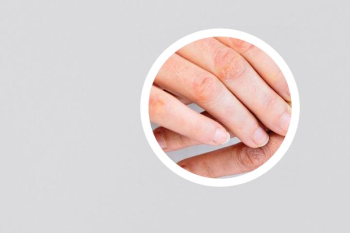 皮炎样银屑病如何缓解