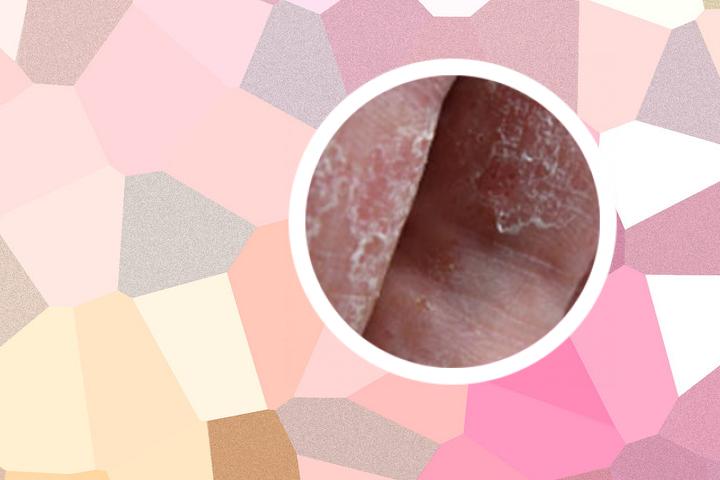 老公有银屑病图片症状