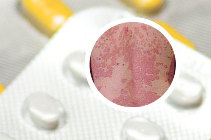 贵州有哪些专业治疗银屑病的医院