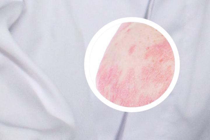 银屑病生物制剂