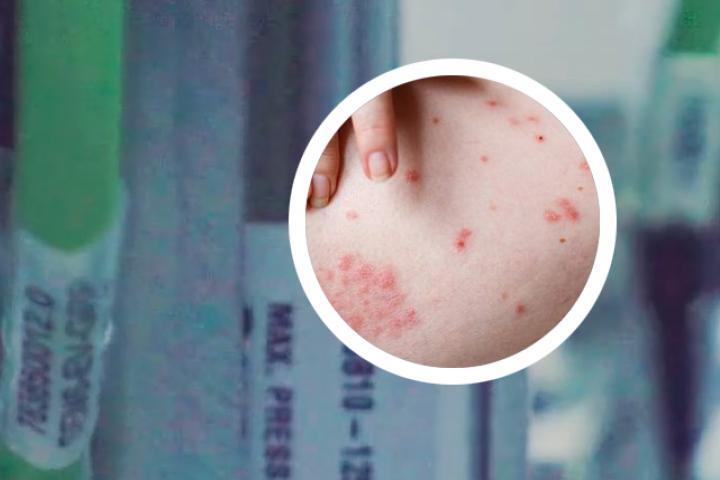 儿子得了银屑病我不想活了