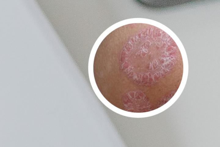 艾灸能治银屑病吗