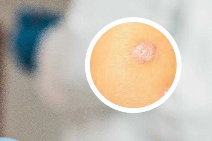 银屑病可以用什么乳膏来缓解症状呢