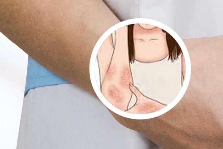 初期银屑病患者占总患者的比例是多少