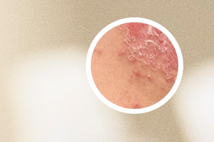 艾草熬水洗治疗银屑病案例