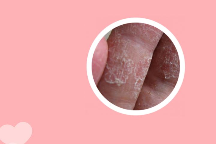 激素药是否对银屑病有害