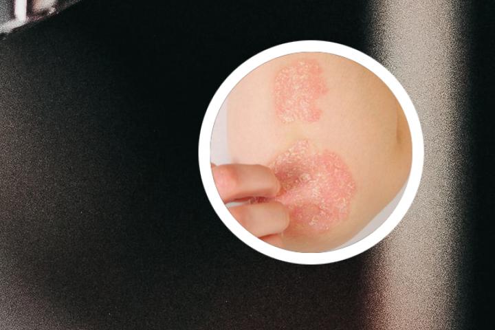 银屑病可以完全治愈吗