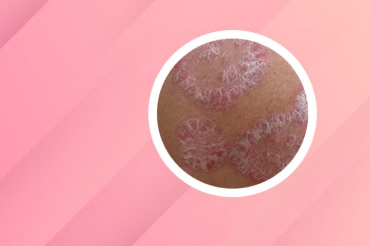 银屑病手指头肿痛怎么办