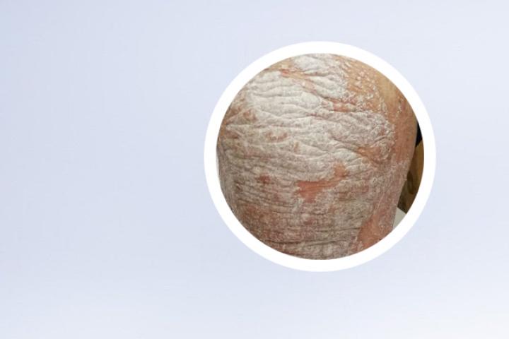 银屑病用什么洗发水效果好