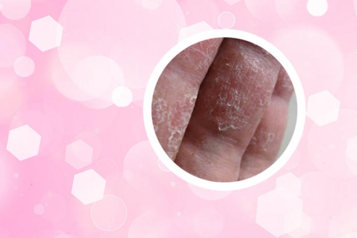 糖尿病合并银屑病治疗方法