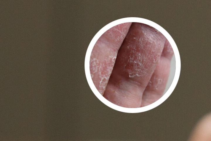 不是所有银屑病都复发