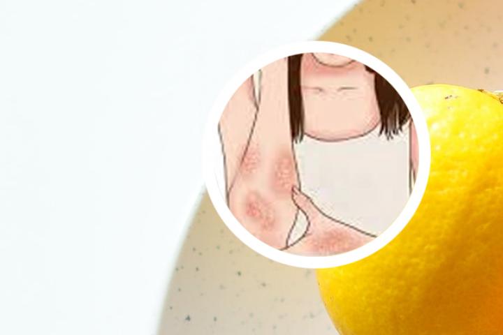 头部牛皮癣卡泊三醇搽剂