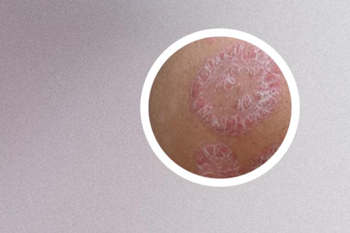 点滴状银屑病打疫苗