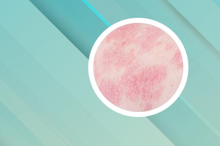 家传秘治牛皮癣方