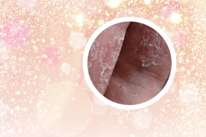 用什么药治疗好银屑病