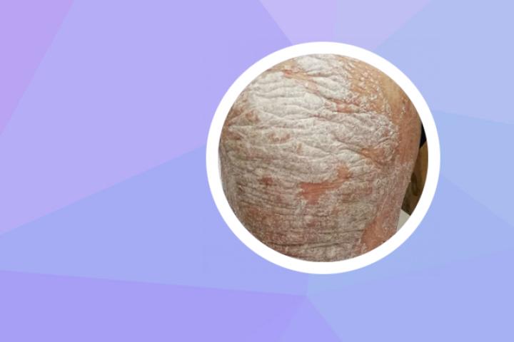 温州哪家医院看银屑病