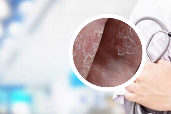 牛皮癣怎样治才彻底根除