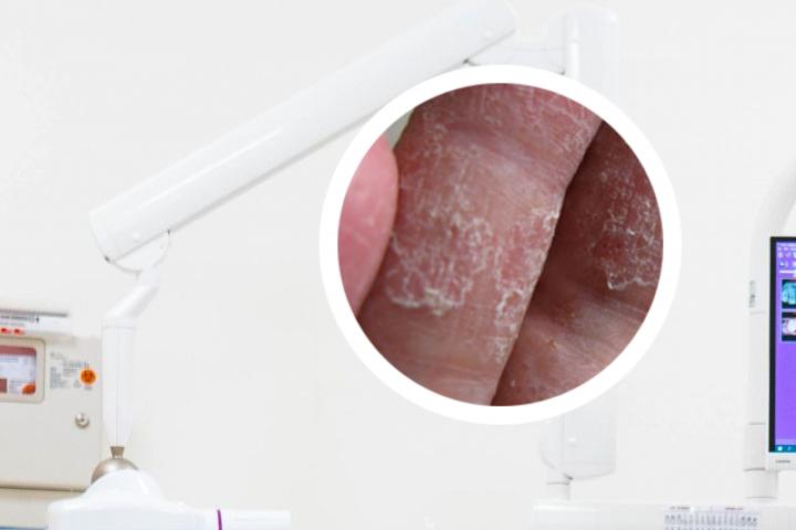 银屑病研究所治疗银屑病怎么样