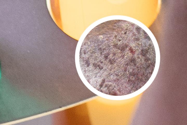 目前治疗银屑病最好的方法